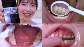 Yuzu Fujita - Observing Yuzu's teeth with a dental mirror & brushing her teeth while wearing a mouth opener & finger toothbrushing while wearing a lip hook - MOV 1080p