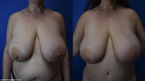 3 month check up before and after. The scar will take about a year to fully heal