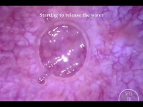 POV Endoscope Catheter Bladder Inflation!