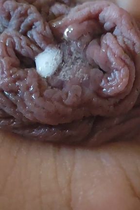 Immense Phimosis Being Extracted Cum and Prcum.