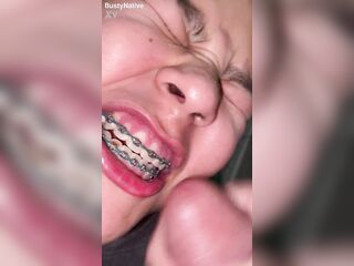 Braces Spunk fountain Immodest teeth