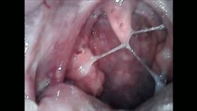 Phlegm endoscopy of the throat & nose wmv