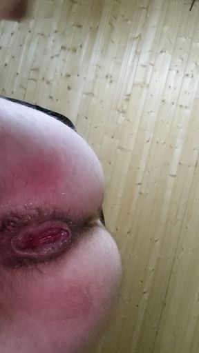 Anal Prolapse,Anal