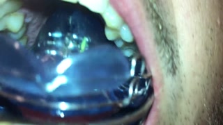 New Braces retainer and Twinblock with headgear for new aventures