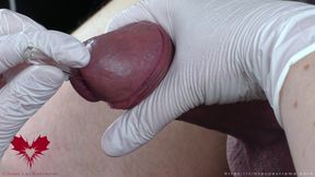 Perfect Extraction of Sperm Directly From the Urethra. Close-up of the Glass Straw Sounding.