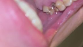 Last Mourth exploration showing my rotten teeth before I fix them at the dentist