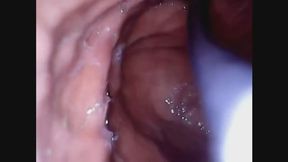 Bailey's Pineapple (Reverse Endoscope Stomach Footage)