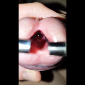 young urethra stretching to maximum, look inside and 10mm dilator inside