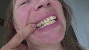 Dental fillings on my teeth 2 b