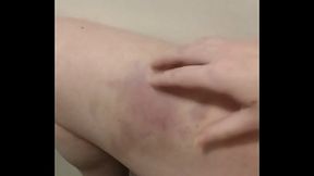 I love playing with my bruises and seeing the way the colours change when you poke them