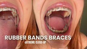 Braces & Elastics Focus; intermaxillary elastics