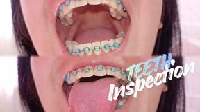 Dental exam while wearing braces