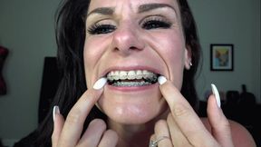 LAUREN'S BRACES & MOUTH TOUR