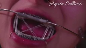 Metal Attraction: The art of a perfect smile.