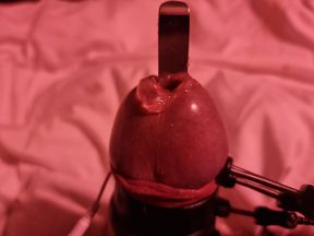 Probe in the urethra and electrode on Et312