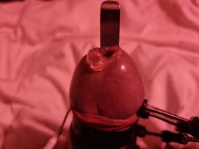 Probe in the urethra and electrode on Et312