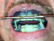 Self facial cumming on braces retainer twinblock with headgear