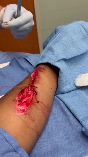Bloody Arm in Medical Setting