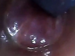 test tube cock endoscope POV urethral insertion ball rod