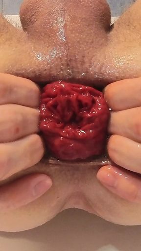 Prolapse