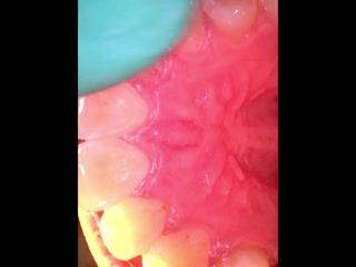 Mouth tour with braces