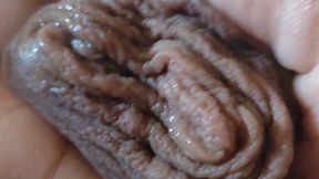 Immense Phimosis Being Extracted Cum and Prcum.