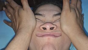 Facelift with Expression Deformity