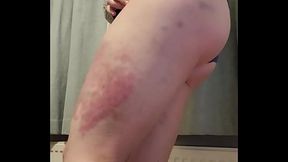 Bruise diary!