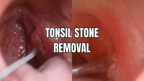 Tonsil stone removal - OnlyVanessa