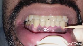 Dirty teeth of a smoker. Dentist role play