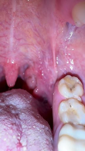 Mouth Secrets: Thick White Coating on My Tongue