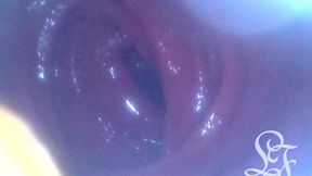 anal endoscope all the way in my transverse colon!