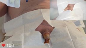 Close-Up insertion of a 16 French foley catheter