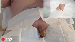 Close-Up insertion of a 16 French foley catheter