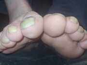 Toenails have gotten long and ugly