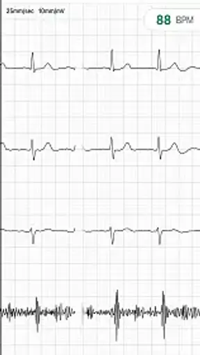 GRAPH ONLY EKG Masturbation and Heartbeat Audio with Eko CORE 500