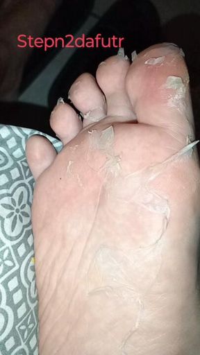 Skin to skin (Foot Skin peeling)