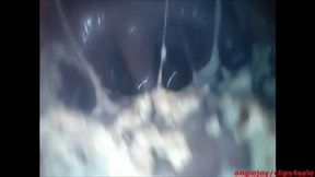 Endoscopy while crushing food wmv