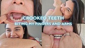Crooked teeth biting my fingers and arms