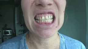 Dental fillings on my teeth