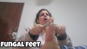 Foot Fungus Scratching - Chubby Feet Toe Fungus Close Up