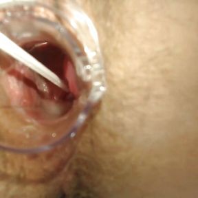 Gyno exam with speculum close up in hairy pussy