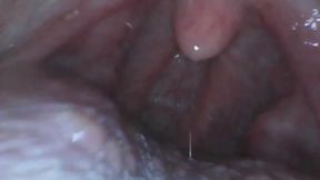 Lynn's Cupcake (ENDOSCOPE FOOTAGE)