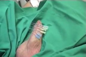 Penis needling in clinic