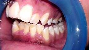 Dental checkup! Showing you the results of the first dental cleaning