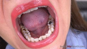 Inside My Mouth - Suzanne - mouth tour, amalgam fillings! (HD quality)