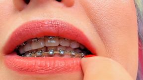 my braces close up