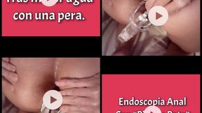 ANAL ENDOSCOPY 2