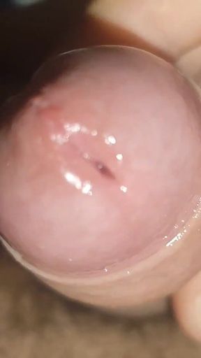 Maximum Dilation of Phimosis Cumming.