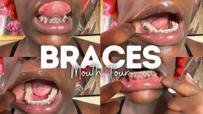 Braces Mouth Tour